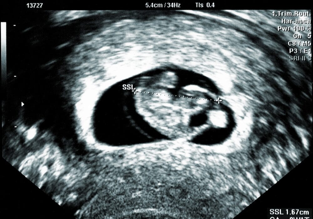 الأسبوع الخامس من الحمل