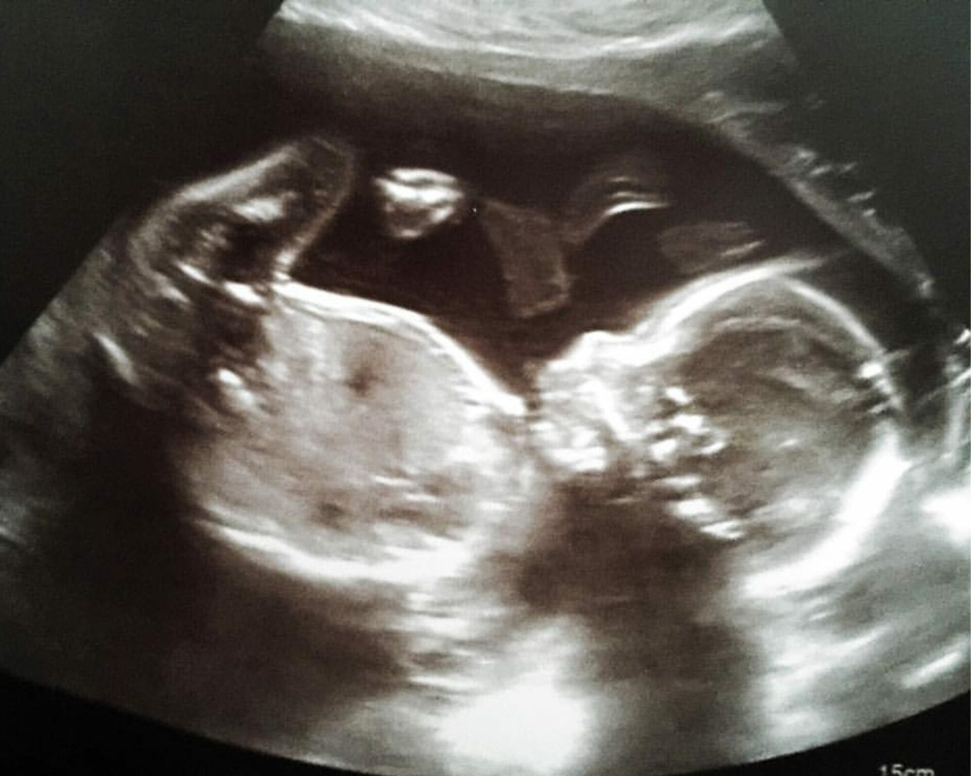 الأسبوع العشرون من الحمل