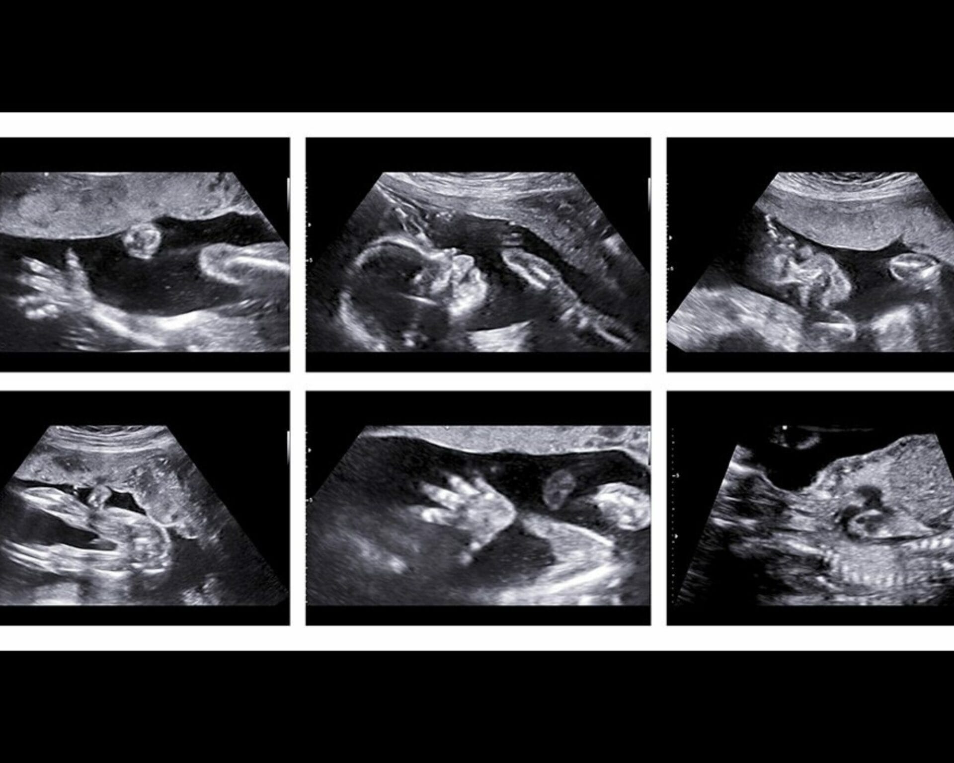 الأسبوع العشرون من الحمل