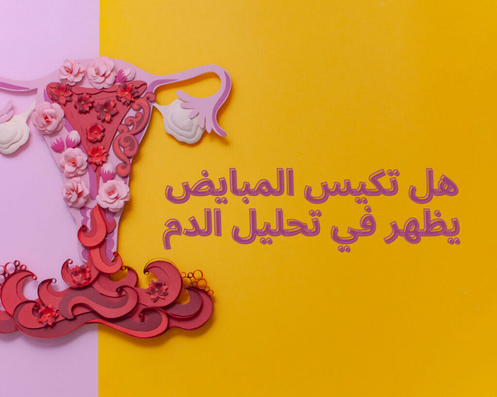 فحص تكيس المبايض بالسونار