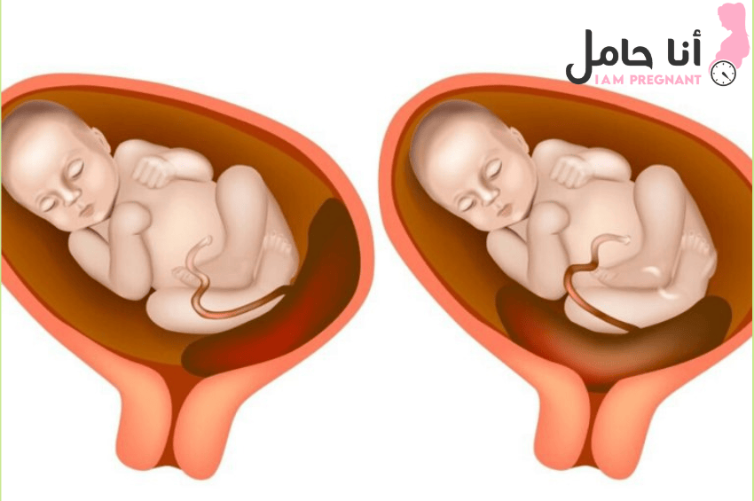 المشيمة تبعد عن عنق الرحم 3 سم