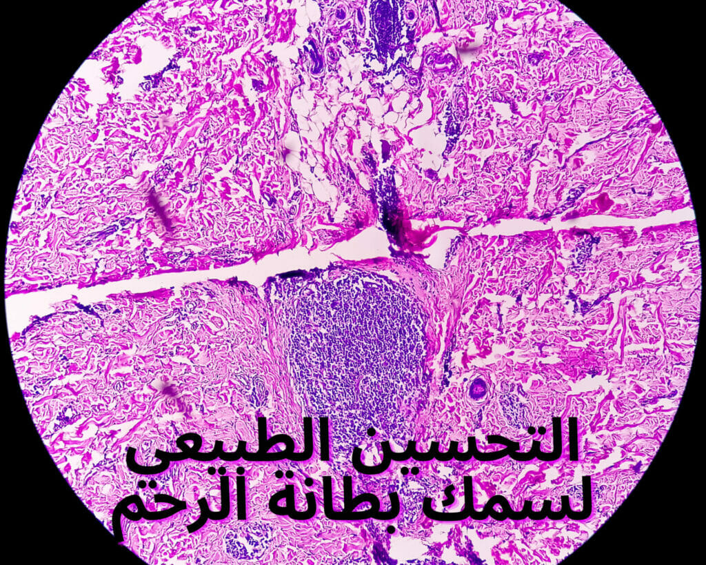 التحسين الطبيعي لسمك بطانة الرحم