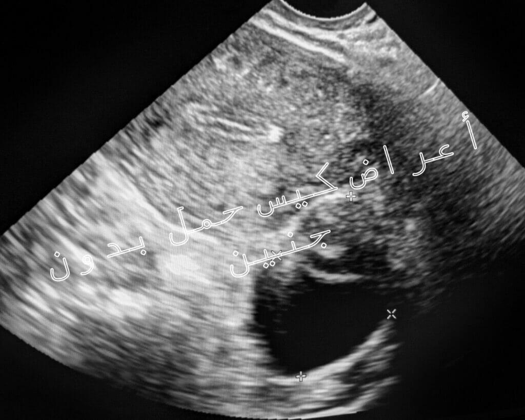 أعراض كيس حمل بدون جنين