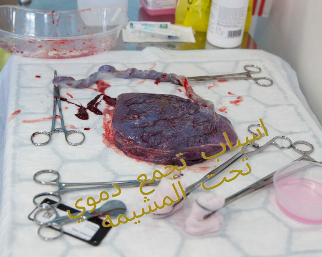 اسباب تجمع دموي تحت المشيمه