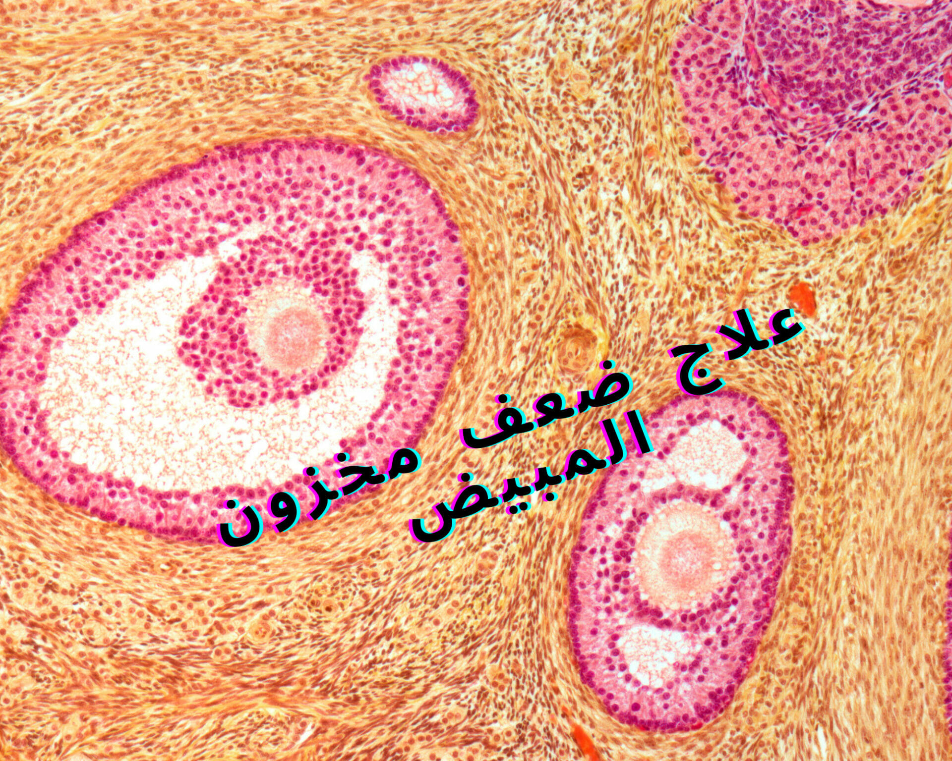 علاج ضعف مخزون المبيض