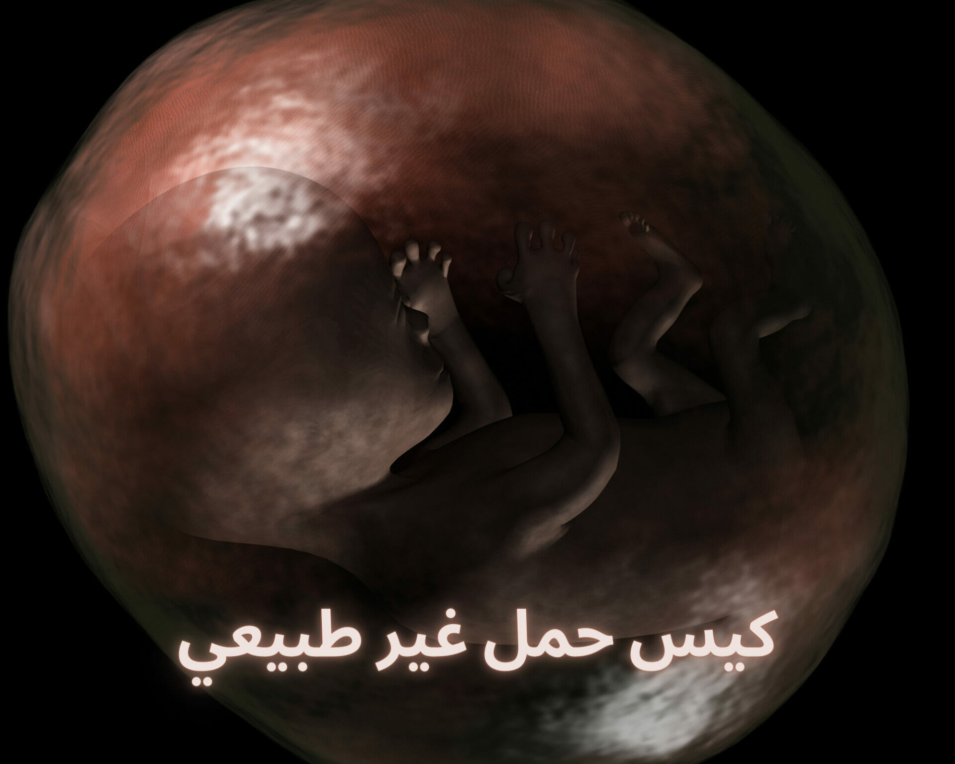 كيس حمل غير طبيعي