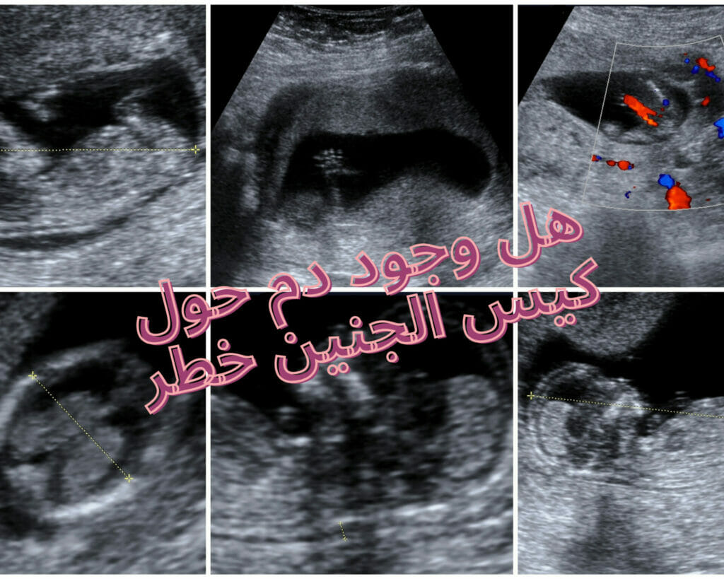 اسباب تجمع دموي تحت المشيمه