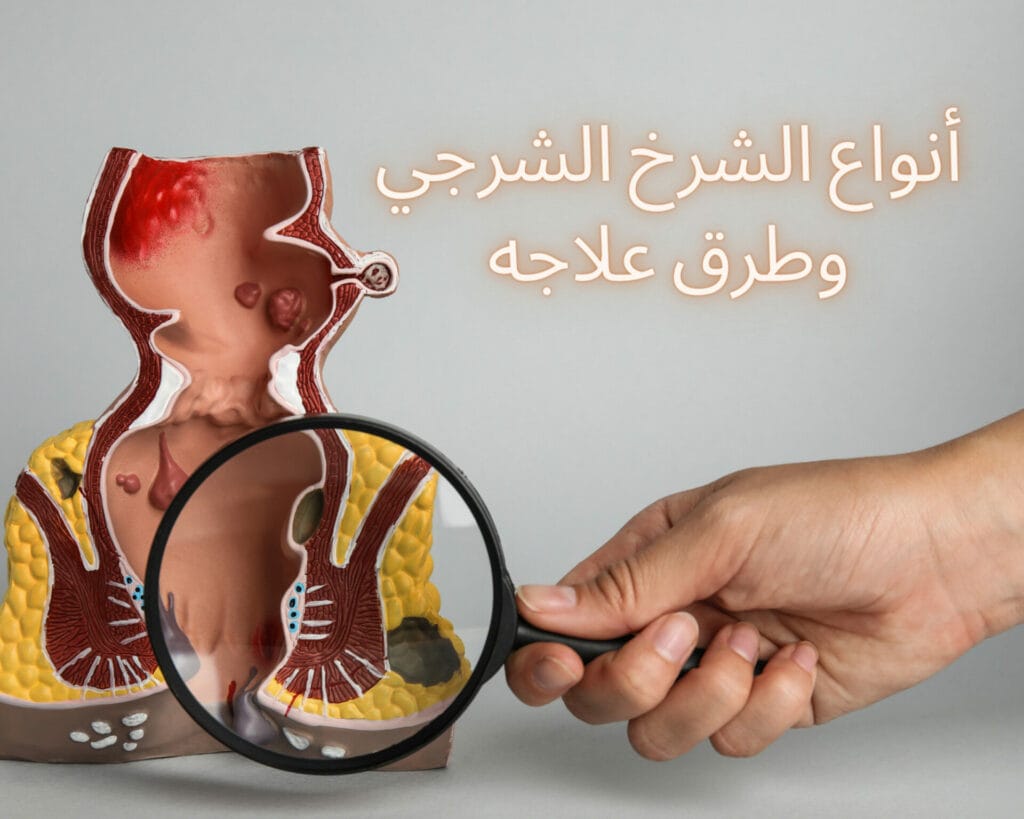 بواسير وشرخ بعد الولادة