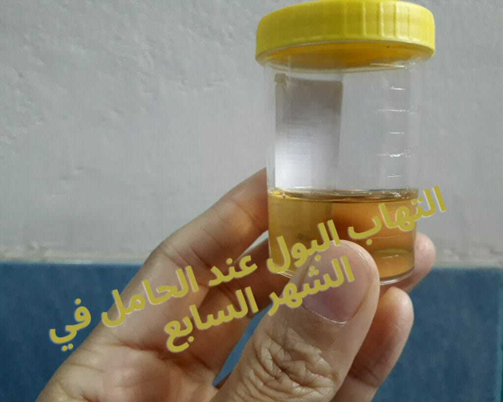 التهاب البول عند الحامل في الشهر السابع