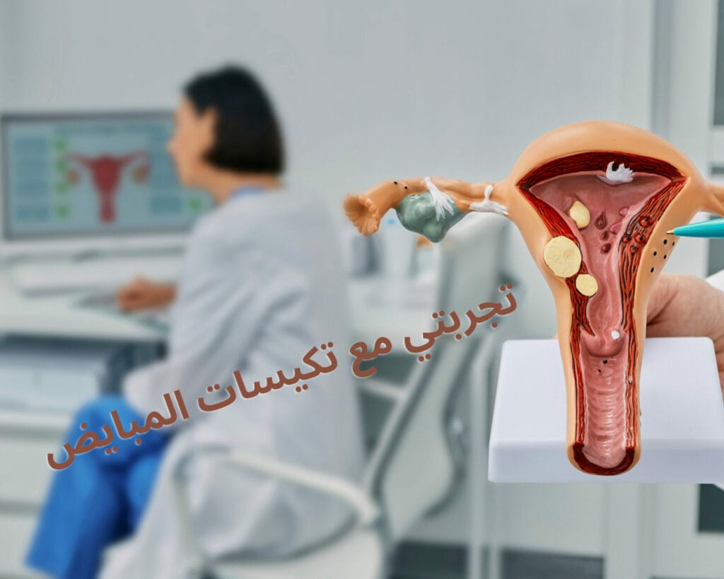 تجربتي مع تكيسات المبايض