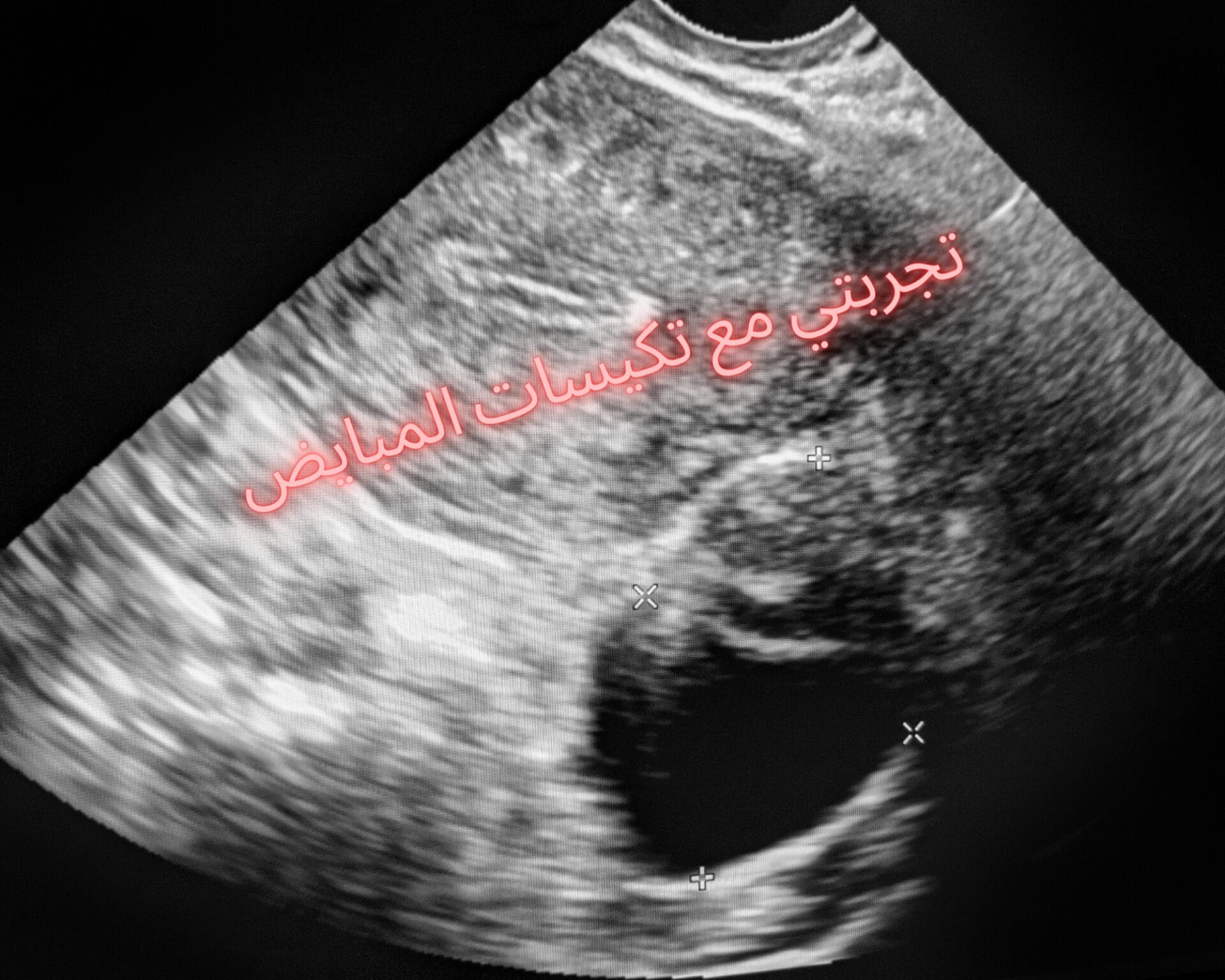 تجربتي مع تكيسات المبايض