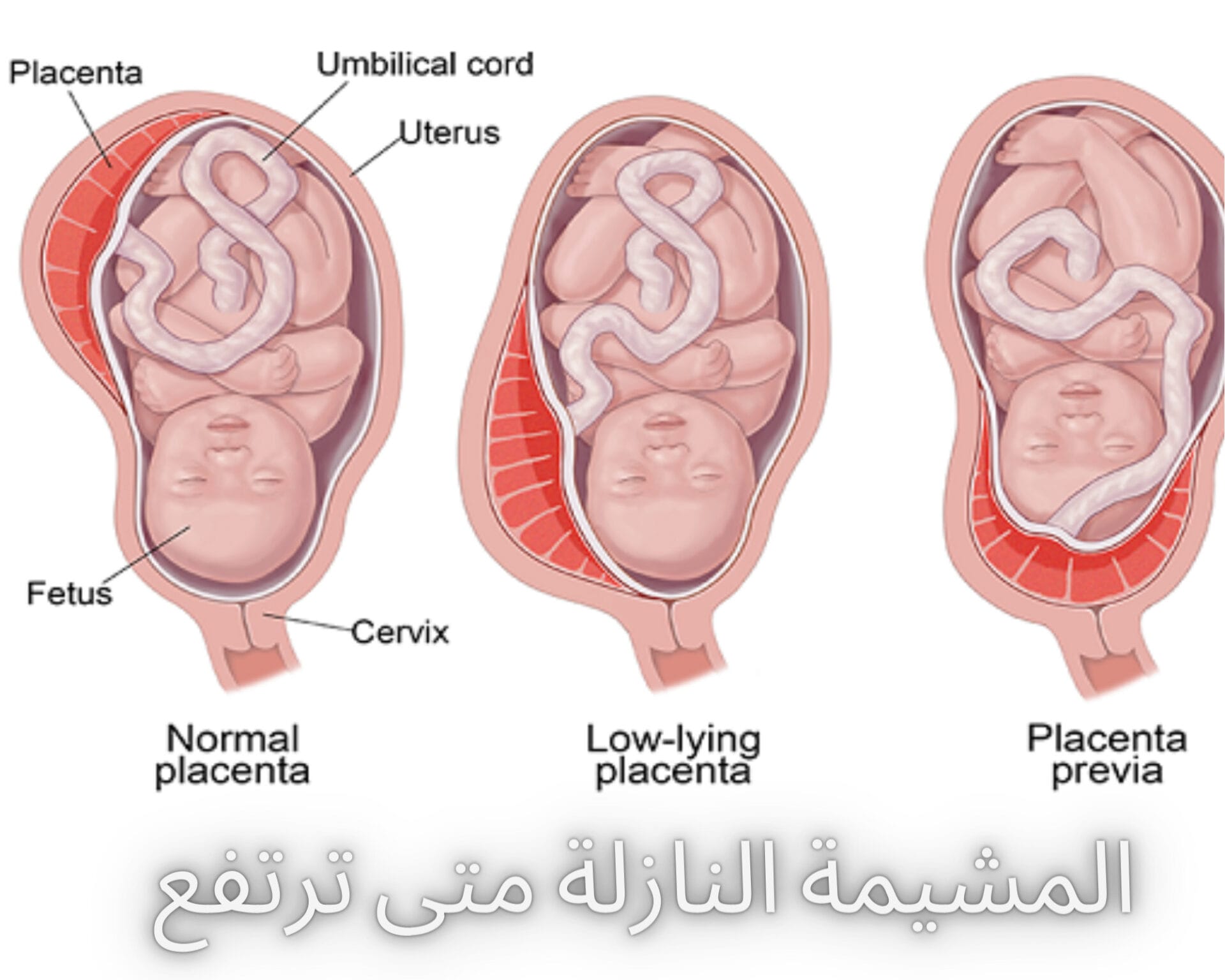 المشيمة النازلة متى ترتفع
