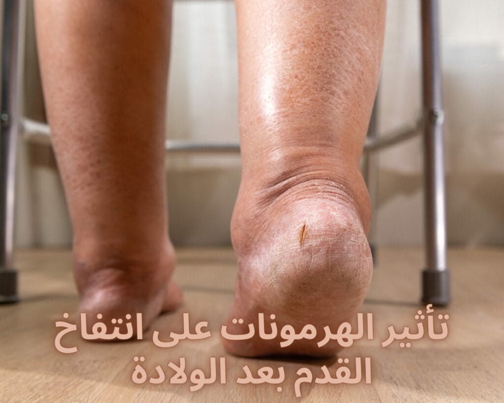 سبب انتفاخ القدم بعد الولادة