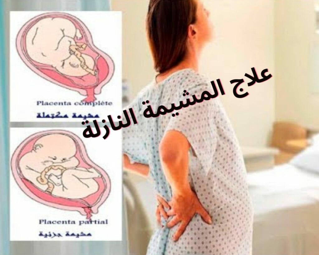 المشيمة النازلة متى ترتفع