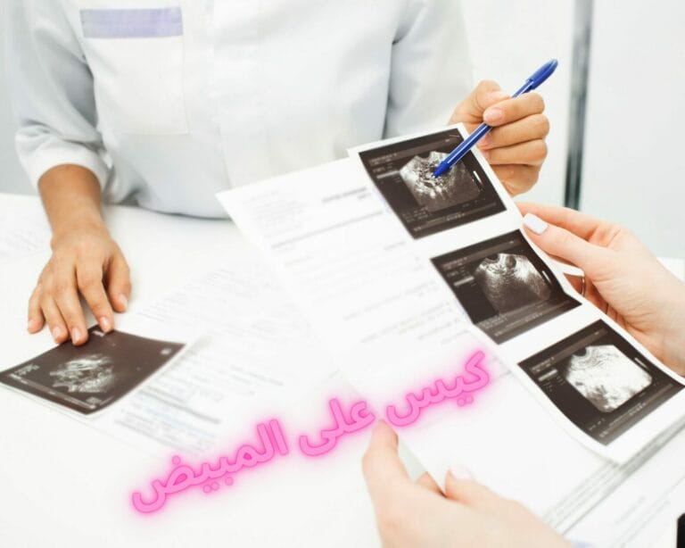 كيس على المبيض