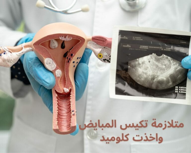 متلازمة تكيس المبايض واخذت كلوميد