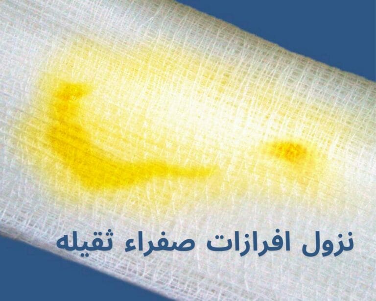 نزول افرازات صفراء ثقيله