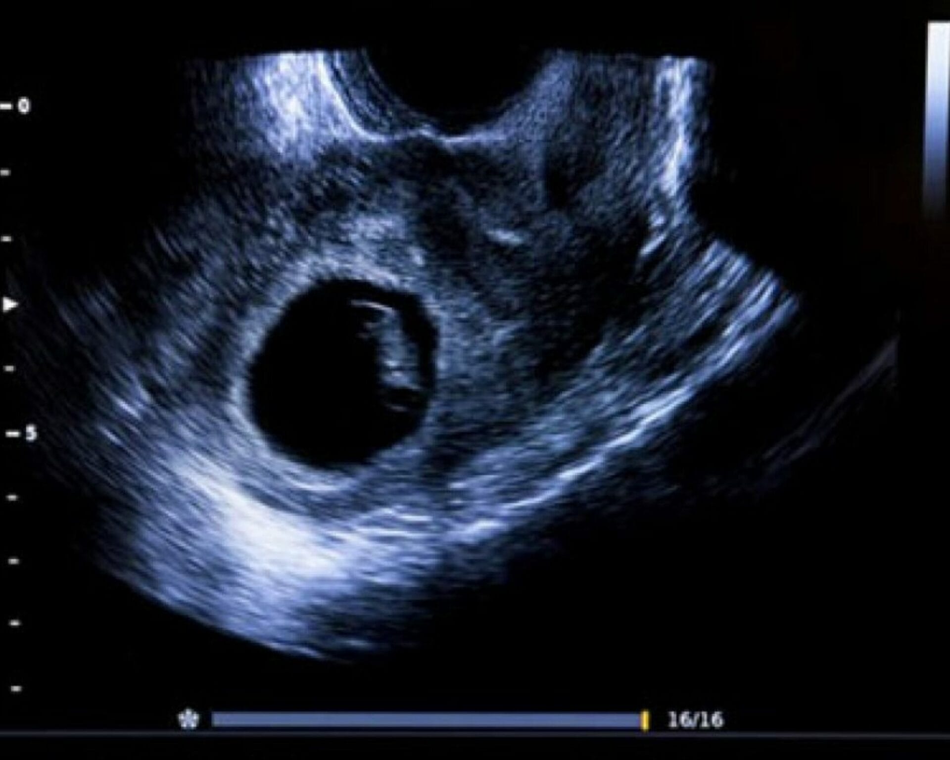 اسباب الحمل بكيس فاضي