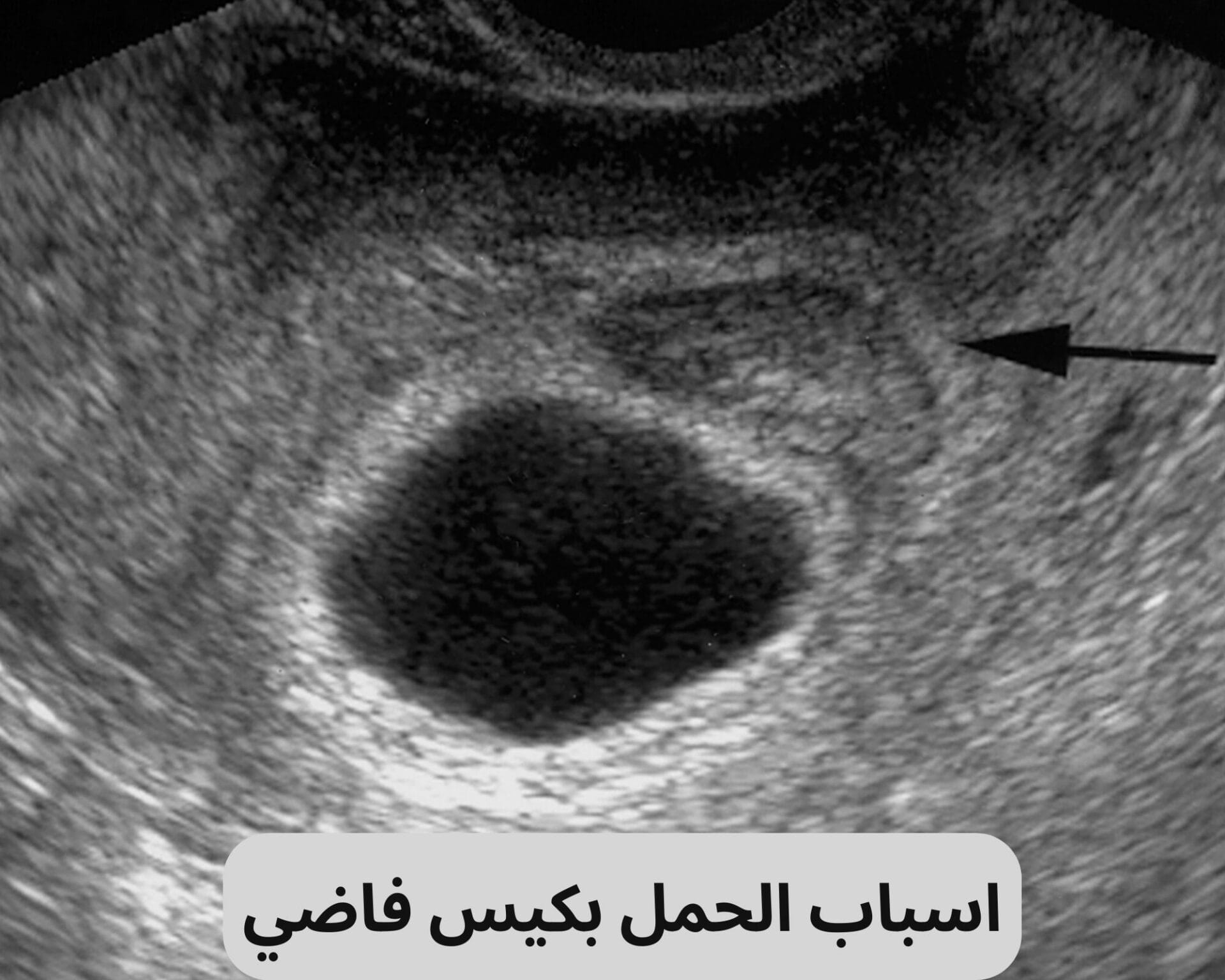 اسباب الحمل بكيس فاضي