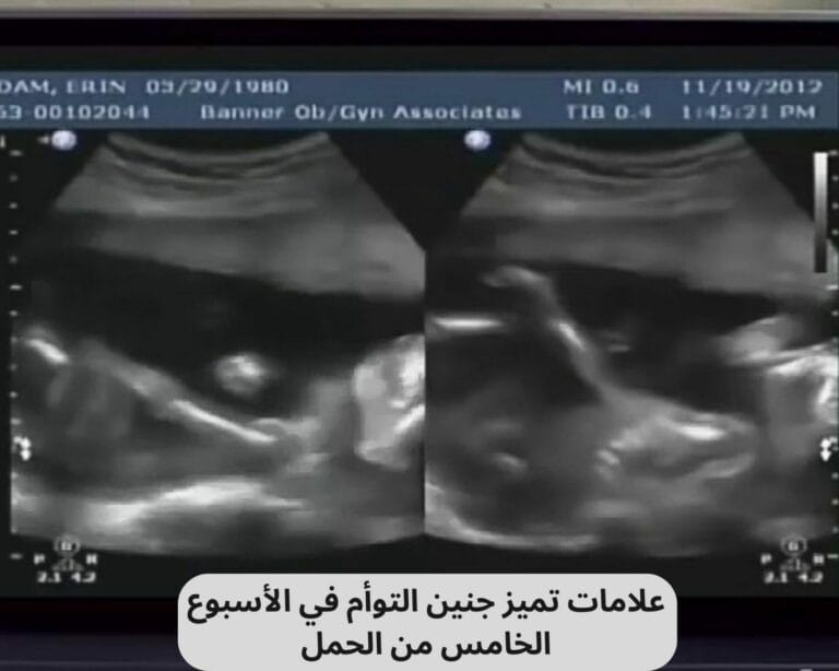 علامات تميز جنين التوأم في الأسبوع الخامس من الحمل