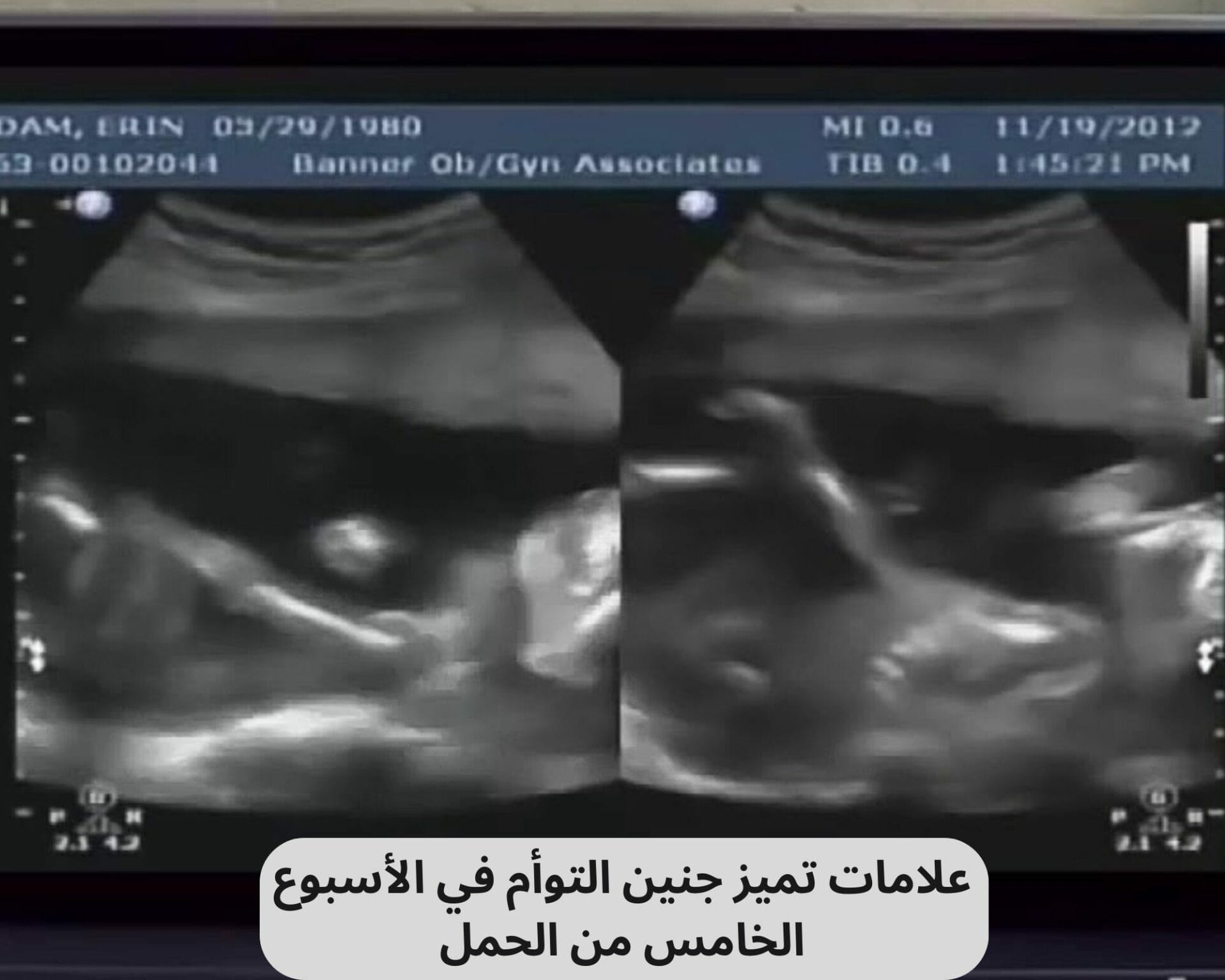 علامات تميز جنين التوأم في الأسبوع الخامس من الحمل